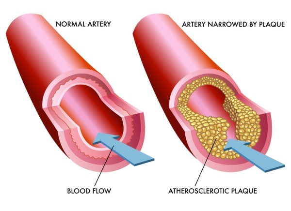 Normal artery and artery blocked by plaque with atherosclerosis