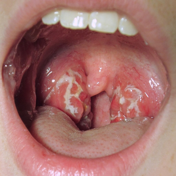 Strep throat with white marks on swollen tonsils