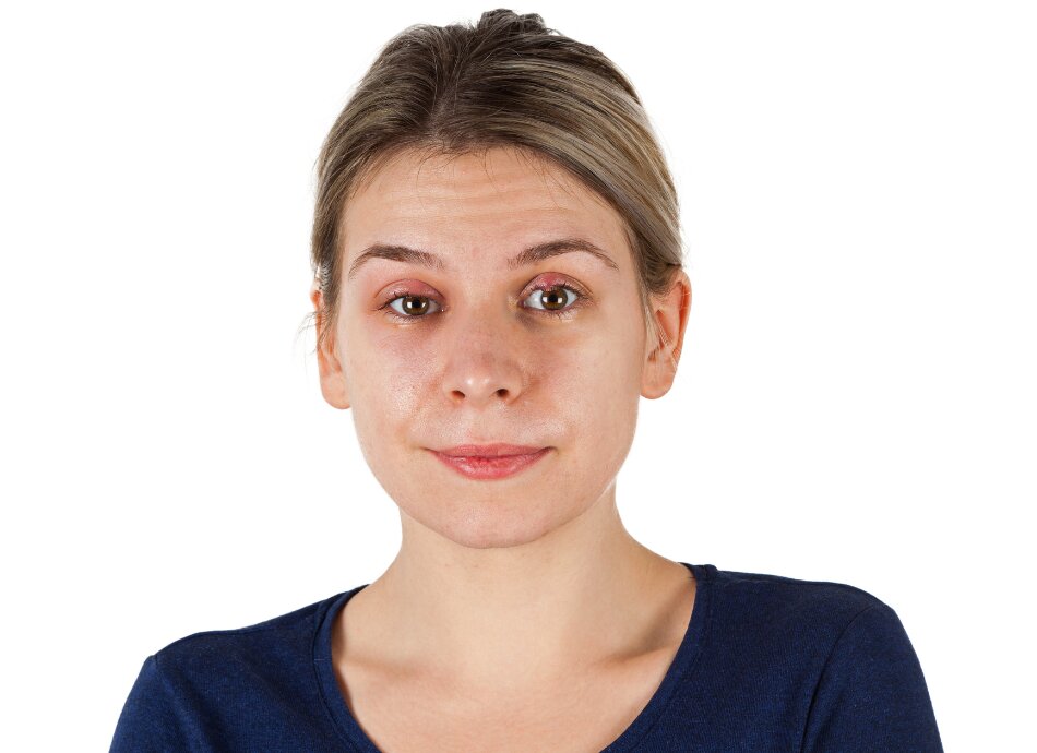 Woman with stye on her left eyelid