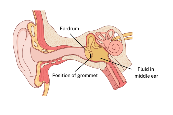 Position of grommet in ear