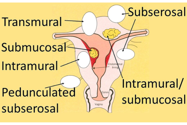 Types of fibroids labelled on uterus image