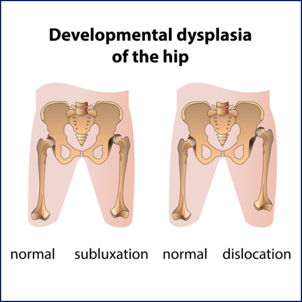 Image showing subluxation and dislocation of hip joints
