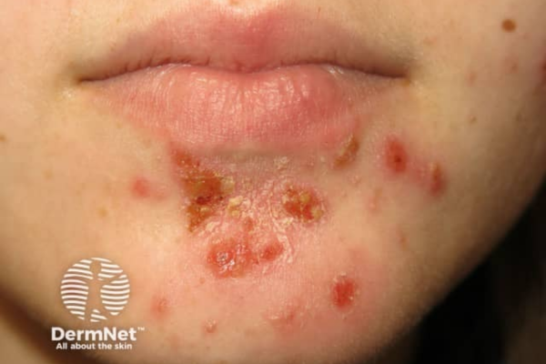 School sores (impetigo) on child's face