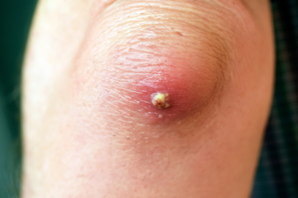 Infected skin with pus on elbow