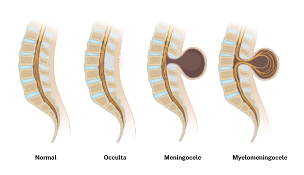 Normal spine and types of spina bifida