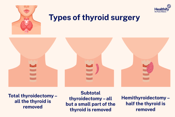 3 different types of thyroid surgery