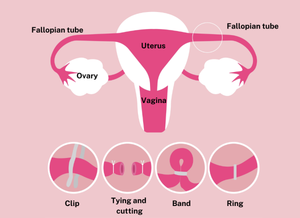 Different types of tubal ligation for contraception