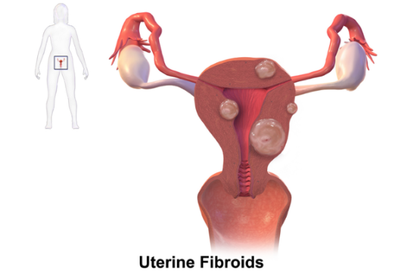 Fibroids in the uterus